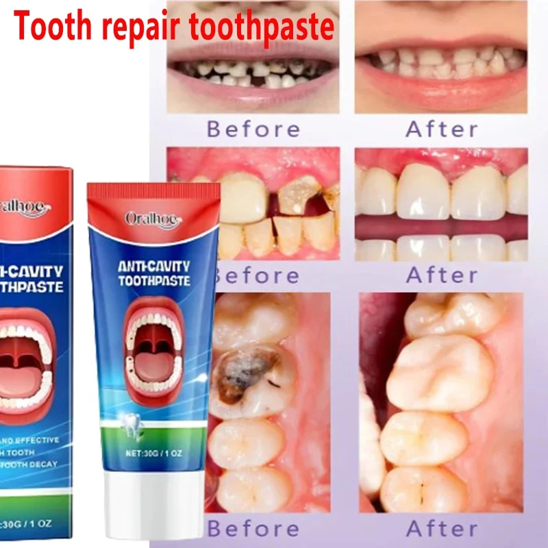 Teeth Health Product 30g Anti Decay Toothpaste Dental Caries Repair Cream Prevent Decay Protect Teeth Remove Plaque Toothache Relieve Periodontitis