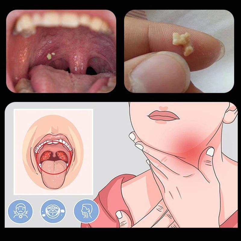 

Ear Wax Tonsil Stone Remover Tool LED Light Stainless Steel Remover Mouth Cleaning Care Tools