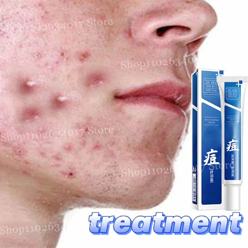 Crema restringente i pori Prodotti per la riparazione del pozzo dell'acne per uomini e donne Rimuovi le cicatrici delle smagliature dell'acne Pelle liscia antinfiammatoria dei pori grandi 1
