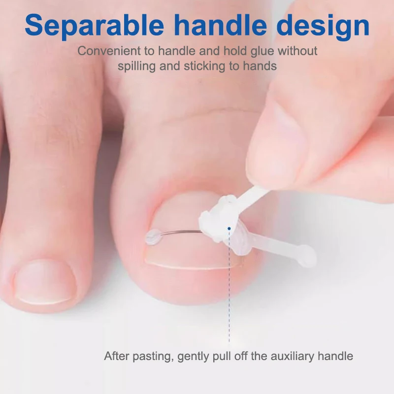 1PC Ingrown Toenail Correction Tool Ingrown Toe Nail Treatment Elastic Patch Sticker Straightening Clip Brace Pedicure Tool toe corrector manicure pedicure tools