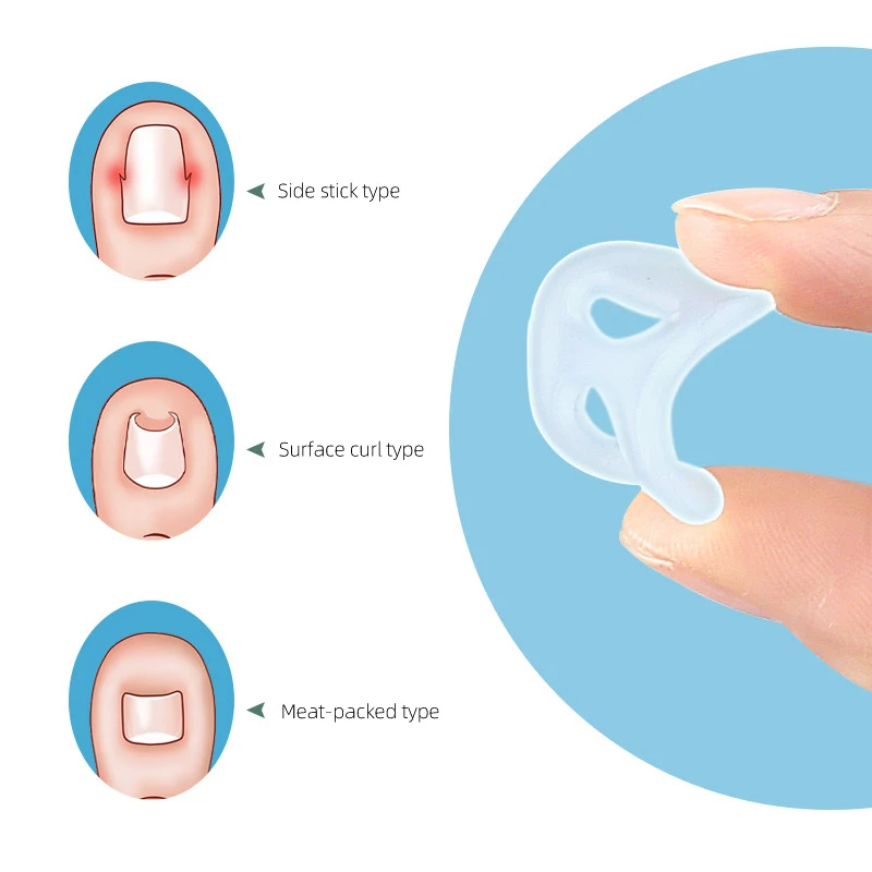 Ingrown Toenail Corrector 2Pcs Silicone Ingrown Toenail Correction Invisible Ingrown Toe Finger Nail Straightening Protector Brace Pedicure Feet Care Tool