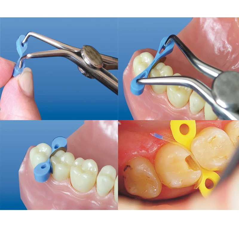 Dental Transparent Sectional Contoured Matrices 30pcs/box Width 7mm Narrow 5mm Matrix Polyester Russian Matrices Dentist