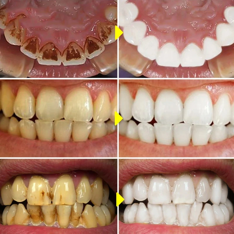 V34 Teeth Whitening Toothpaste 5d Tooth Whitener Strips Oral Hygiene Dental Bleaching Tools