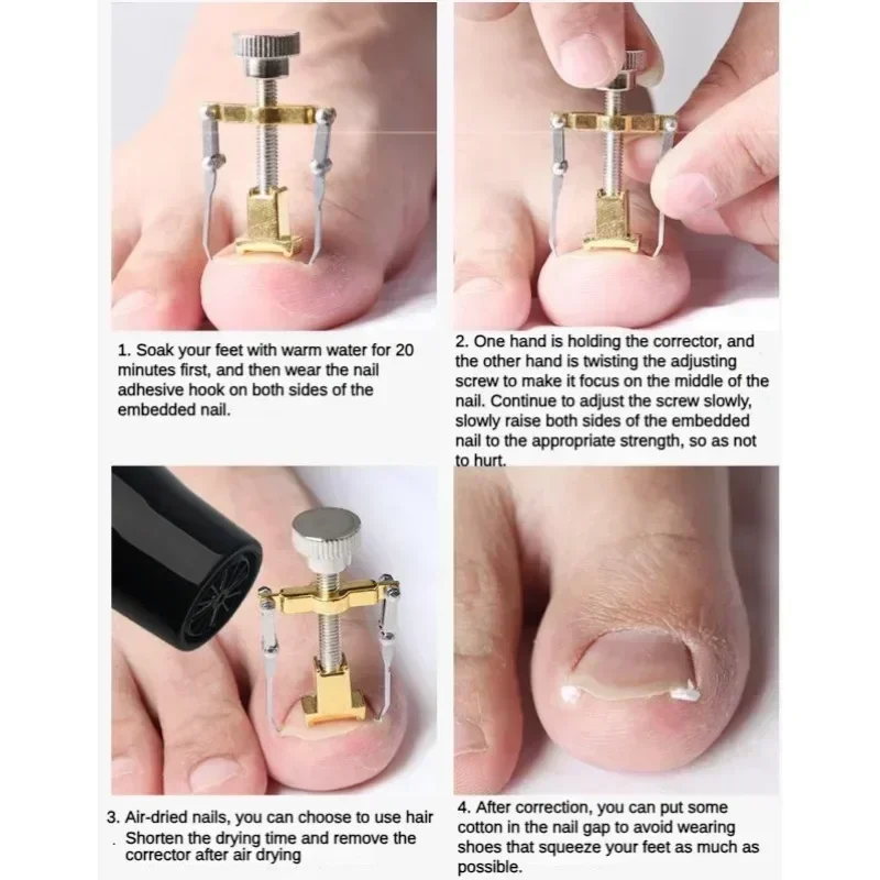 Ingrown Toenail Corrector Straightening Clip Pedicure Foot Nail Care Tools Stainless Steel Pedicure Treatment Onyxis Correction 3