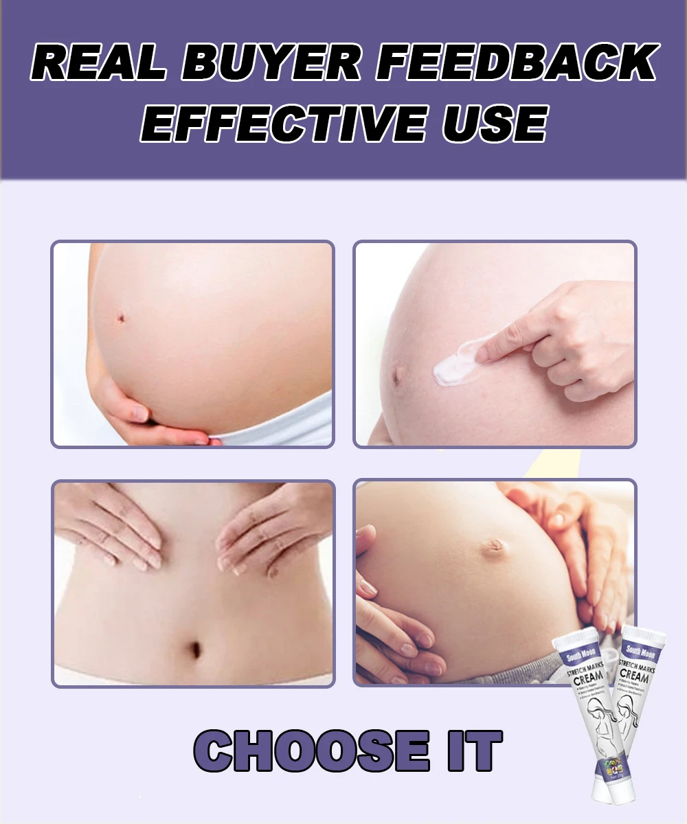 Stretch mark removal cream, Postpartum repair of fat marks on thighs, Stretch mark removal cream