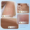 Keratosis Pilaris Cream – Smooth & Clear Skin