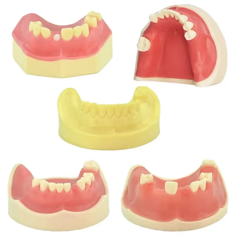

Модель зубного импланта, модель зубного импланта, модель для обучения стоматологии, стоматологический инструмент, пять типов