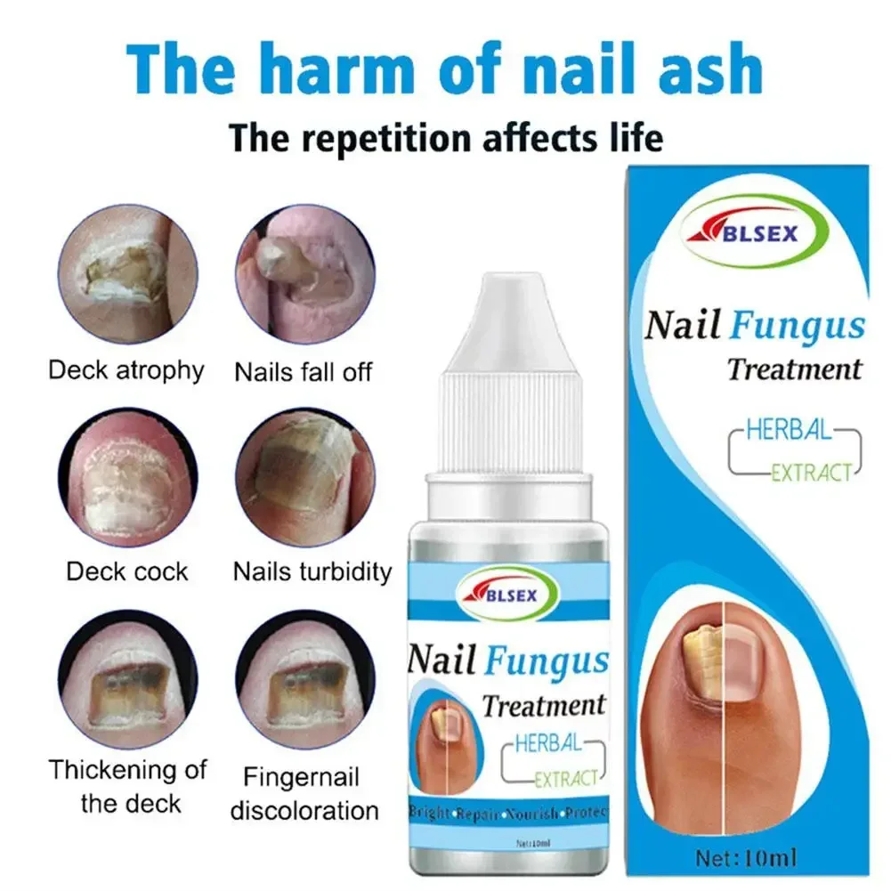 U&ntilde;as Fungus Nails Treatment for Fingernails Toenails Repair Onychomycosis Paronychia Anti Infection Toe Nail Fungal Removal