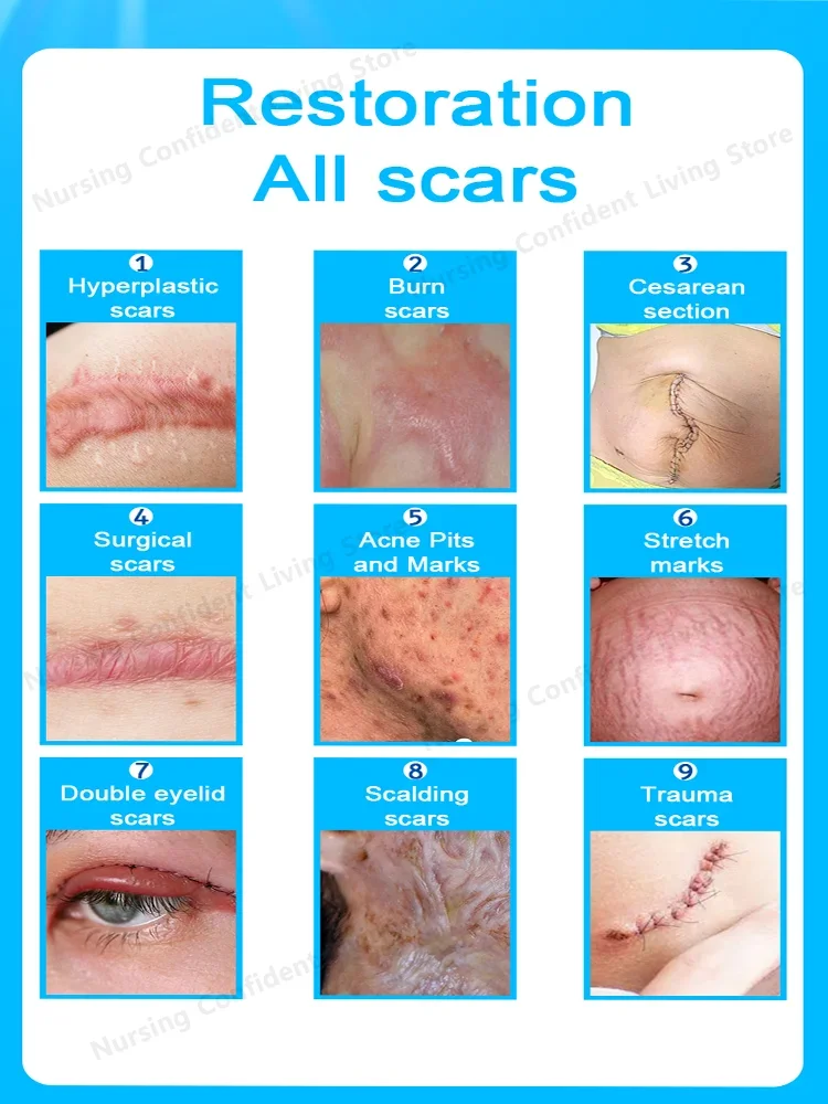 Laser scar repair 6