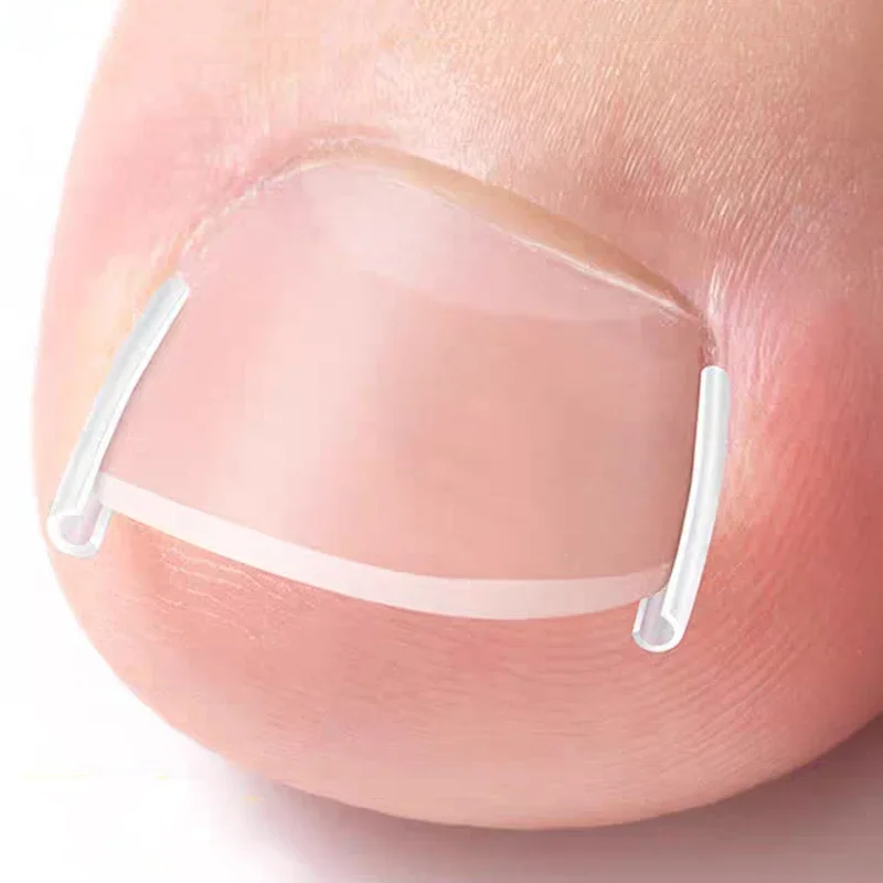 Medical Grade Plastic Ingrown Toenail Corrector Tool