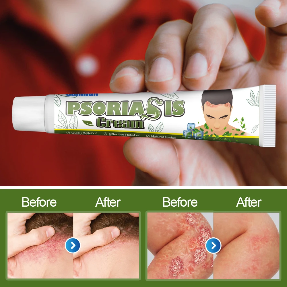 Sumifun Seborrheic Dermatitis Ointment Treatment Dermatitis Eczema Head Acne Pruritus Repair Scalp Hair Care Cream 20g skin care ointment