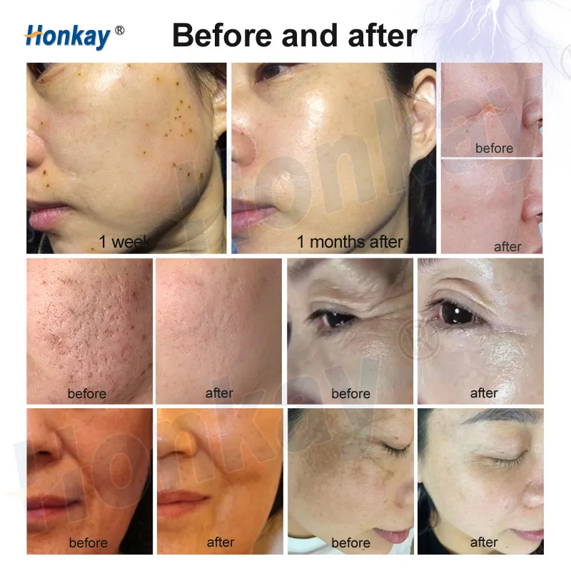 Plasma Pen Professional Machine Fibroblast Ozone Plasma Device Lifting Skin Tightening Wrinkle Acne Remove Beauty Equipment
