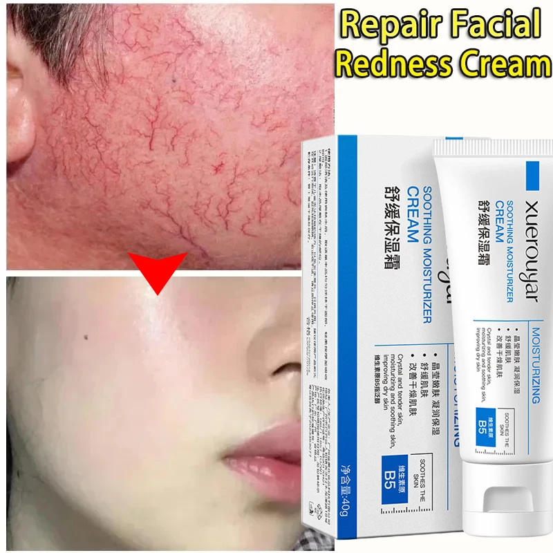 

Facial Redness Repair Cream Improve Sensitive Skin Redness Rosacea Itching Instant Spider Vein Treatment Anti Aging Skin Care