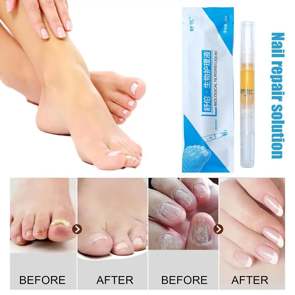 Nail Repair Liquid Pen Fungus Treatment Anti Fungal Repair Biological Solution Onychomycosis Pencil Rehydration Nutrient R2O2