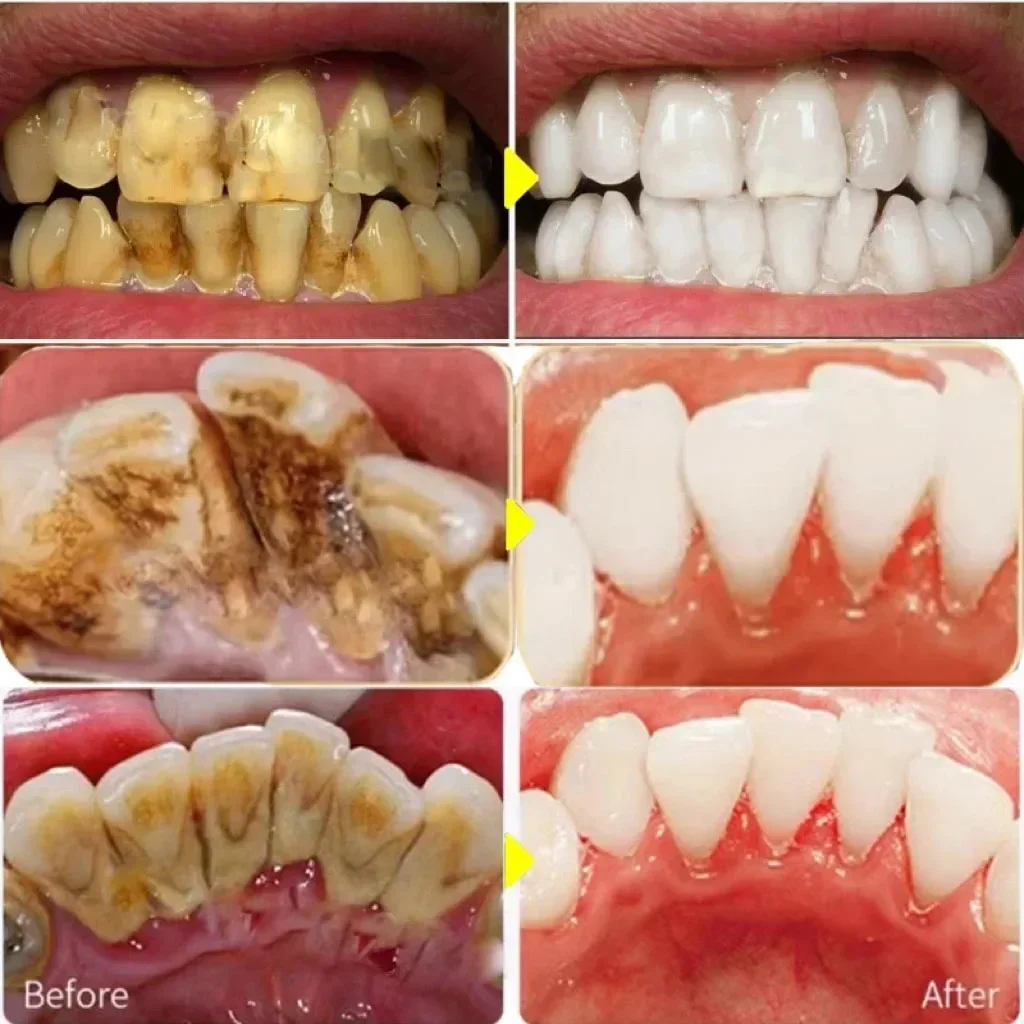 Dental Calculus Remover Teeth Whitening Spray Toothpaste Cleaning Oral Hygiene Removal Halitosis Plaque Stains Fresh Breath Care dental calculus remover