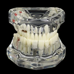 Comprehensive Dental Disease Teaching and Research Models (Transparent)