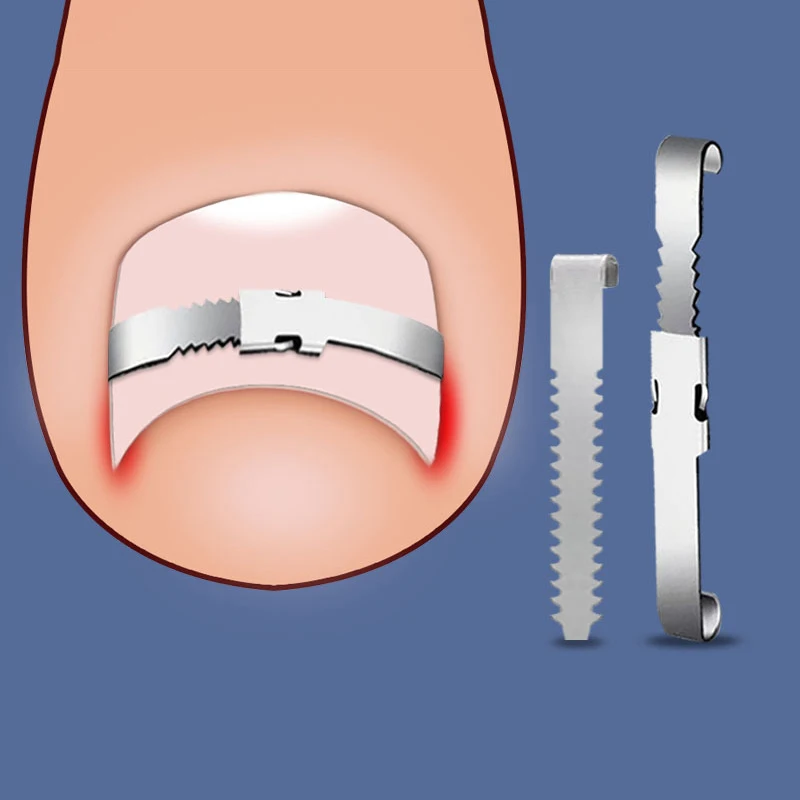 Ingrown Toenail Corrector Tools Pedicure Recover Embed Toe Nail Treatment Professional Ingrown Toenail Correction Foot CareTool toe corrector foot care tool ingrown toenail correction tool foot pedicure tool mens foot care product