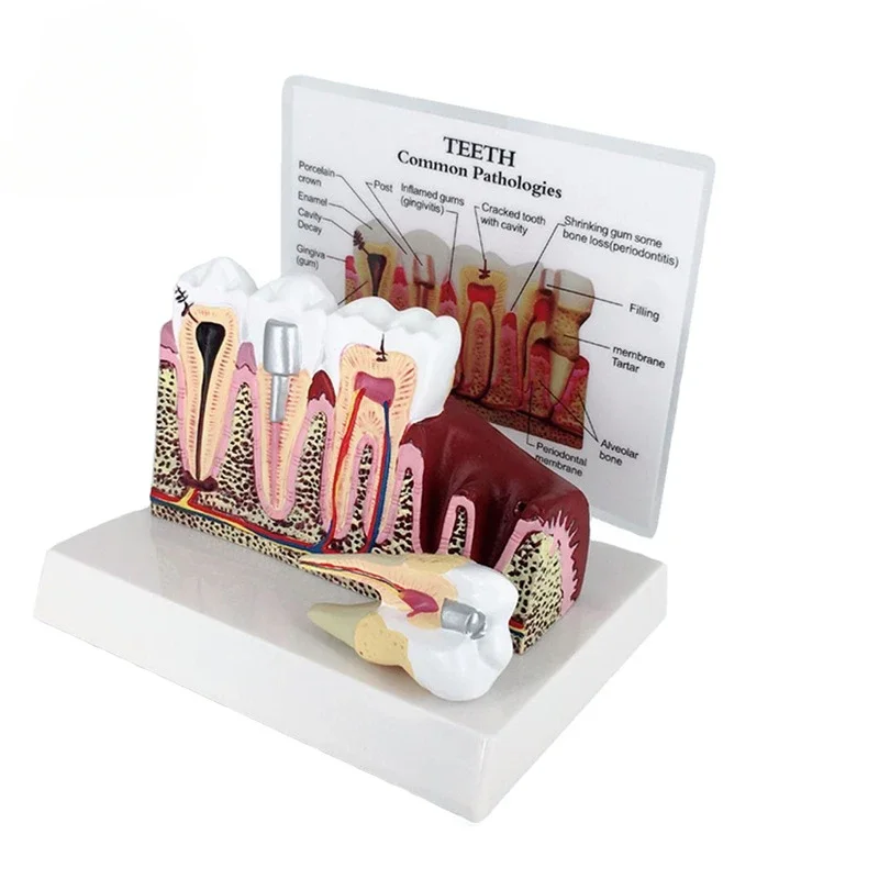 

Teeth Common Pathologies Disease Model Tooth Decay Gingival Anatomy Dental Medical Teaching Model