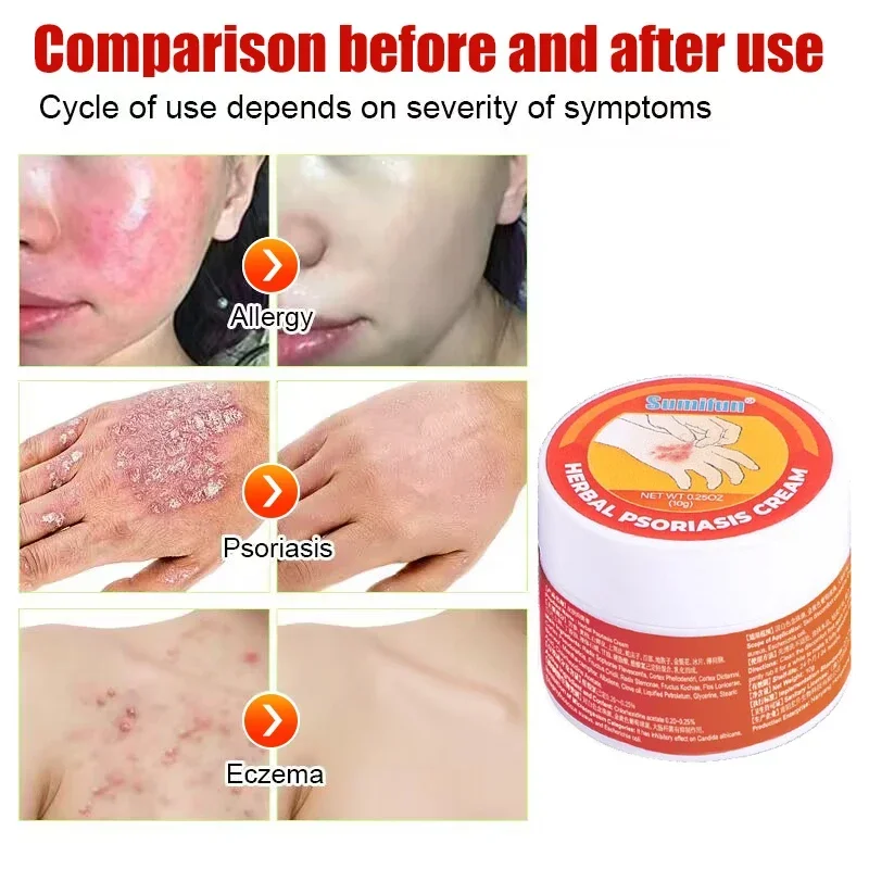 Herbal Skin Cream for Psoriasis Dermatitis