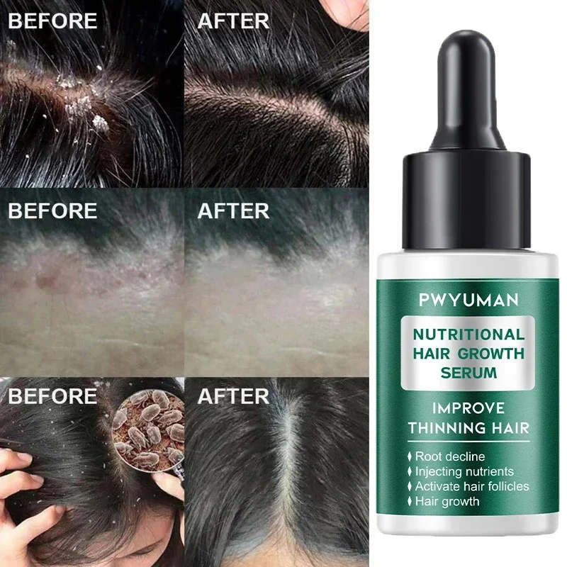 Hair Scalp Treatment Essence Spray Dandruff Itching Oil Control Anti Loss Scalp Cleaning Repair Serum Beauty Hair Care Products hair treatment scalp treatment