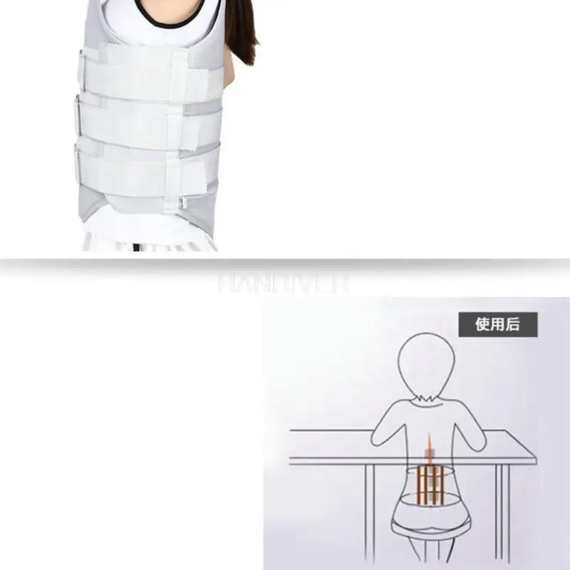 Low-temperature thermoplastic thoracic lumbar fracture fixed with a thoracolumbar spinal column brace with airbags