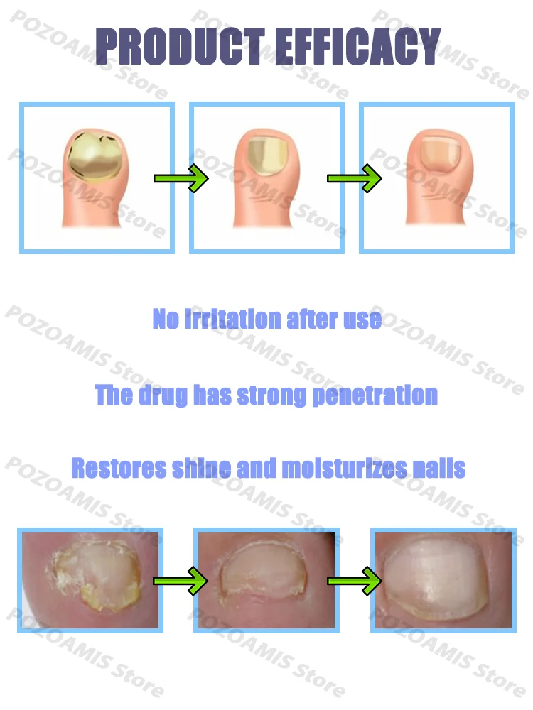 Onychomycosis killer, solve fungal problems, foot care