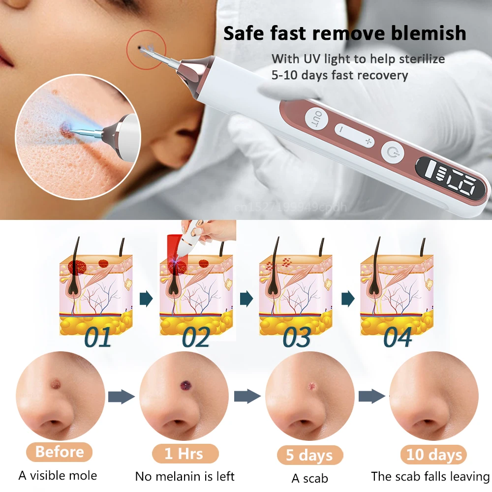 Skin Tag Removal Tool Skin Tag Removal Pen Laser Plasma Pen Black Dots Mole Wart Remover Pen Dark Spot Remover For Face Body Blemish Removal Laser Skin Tag Removal