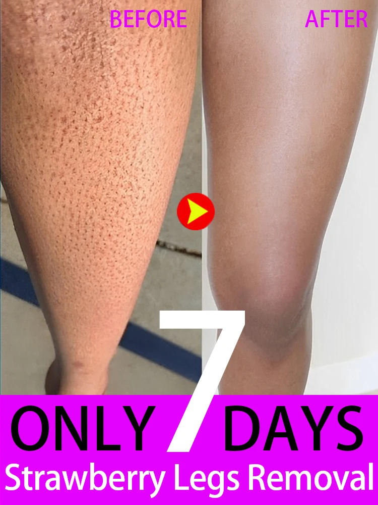 Keratosis Pilaris Removal Cream for Strawberry Legs Hydrating