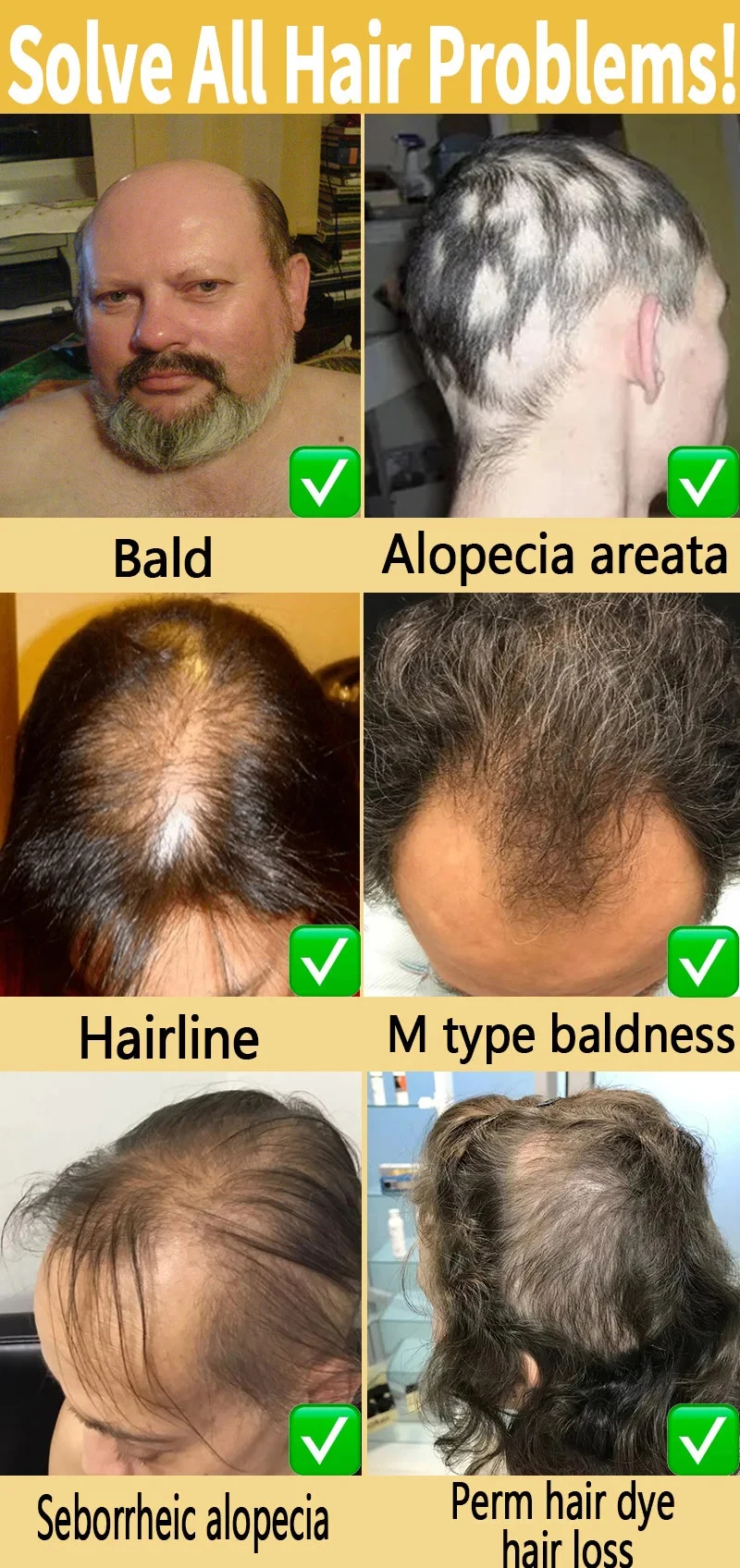 Description Picture 6 of itemHair Growth Spray Anti Hair Loss Essence Hair Regrowth Serum Treatment Alopecia Prevent Baldness Nourish Scalp 30ml