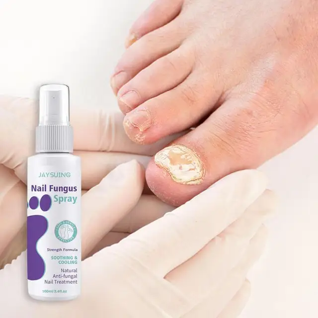 Athlete Feet Spray: The Ultimate Nail Care Solution