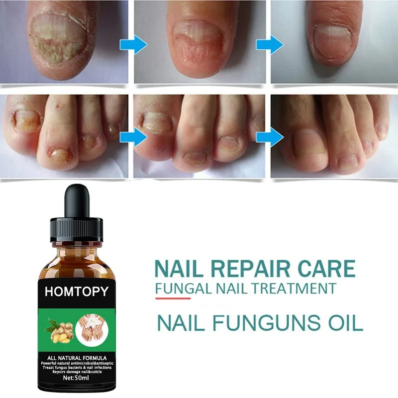7 Days Nail Fungus Remover Serum Oil Foot Toe Nail Fungus Removal Repair Onychomycosi Anti Infection U&ntilde;as Care Products
