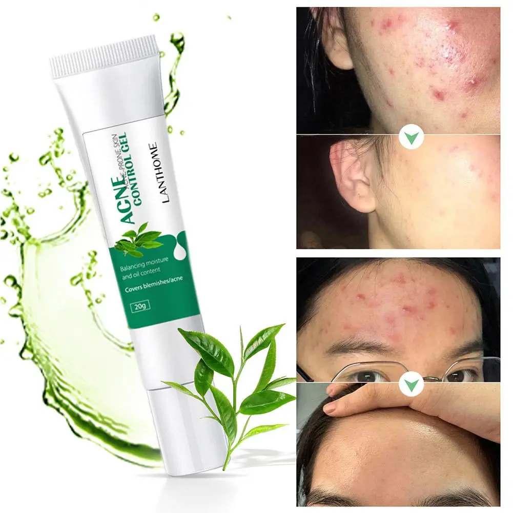 

20g Herbal Acne Cream To Remove Acne And Eliminate Oil Control Marks Efficient Care Acne Acne Treatment Skin Anti-inflammat I9C5