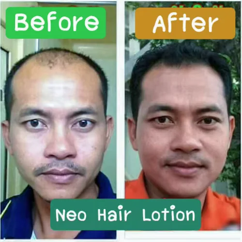 120ml Neo Hair Lotion Hair Root HAIR BEARD SIDEBURNS LONGER Herbs 100% Original Thailand Free Gift