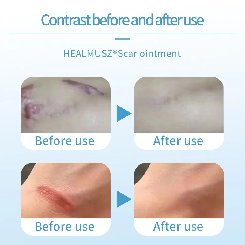 Laser Repair Skin Scars 1-7pcs Powerful Scar Removal Cream Fast Remove Deep Skin Scar Blue Light Therapy Pen Recovery Cream