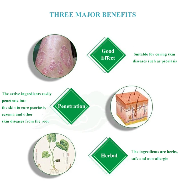 Psoriasis Krém Ekcéma Kenőcs Kezelés Kéz Tinea Pedis Gátolja A Dermatitis Gombaellenes Krémet - Image 3