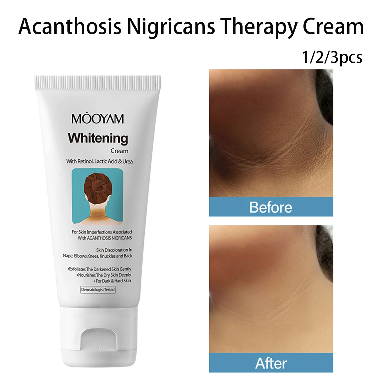 

Acanthosis Nigricans терапевтический крем для тела и шеи для подмышек, локтей, суставов и подмышек, крем для ухода за кожей