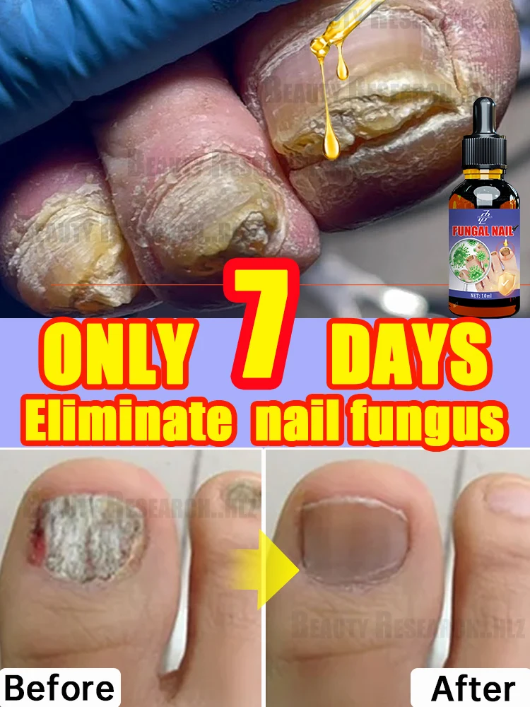 Treatment of Onychomycosis and Fungal Nails