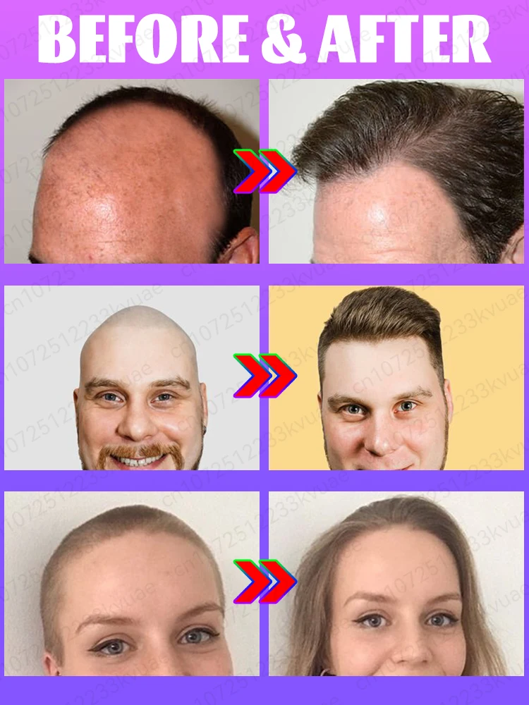 Hair Treatment Oil Hair Treatment Scalp Treatment Rapid hair growth serum treating alopecia areata seborrheic alopecia hereditary alopecia etc.