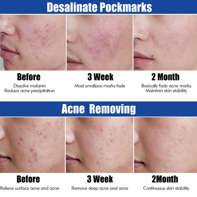 Pattanás Kezelés A Szérum 100% Egf Tiszta Természetes Esszencia Hatékonysága Súlyos Pattanások Eltávolító Pattogó Javítás Bőrfehérítés - Image 5