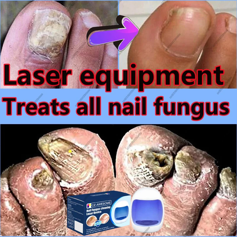 Fungal Nail Laser Device Repair Fast  Nails Fungus Onychomycosis