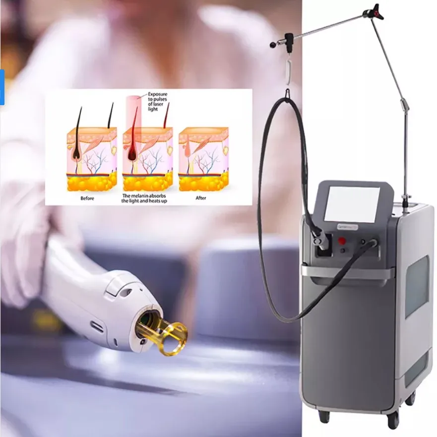 لیزر الکساندرایت