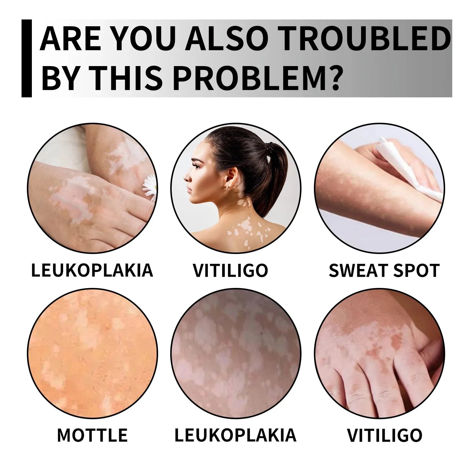 Spray anti-Vitiligo, élimine les taches blanches de la teigne, élimine les taches de sueur, traitement de la leucoplasie, répare, hydrate la peau, liquide de soin_voghion.com