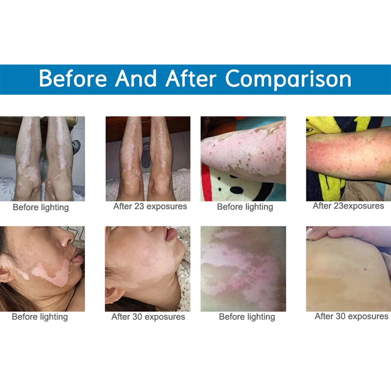 311nm Ultraviolet Phototherapy Instrument Handheld Use UVB Lamp for Vitiligo Treatment Psoriasis Lamp Skin Disease Device - Image 3