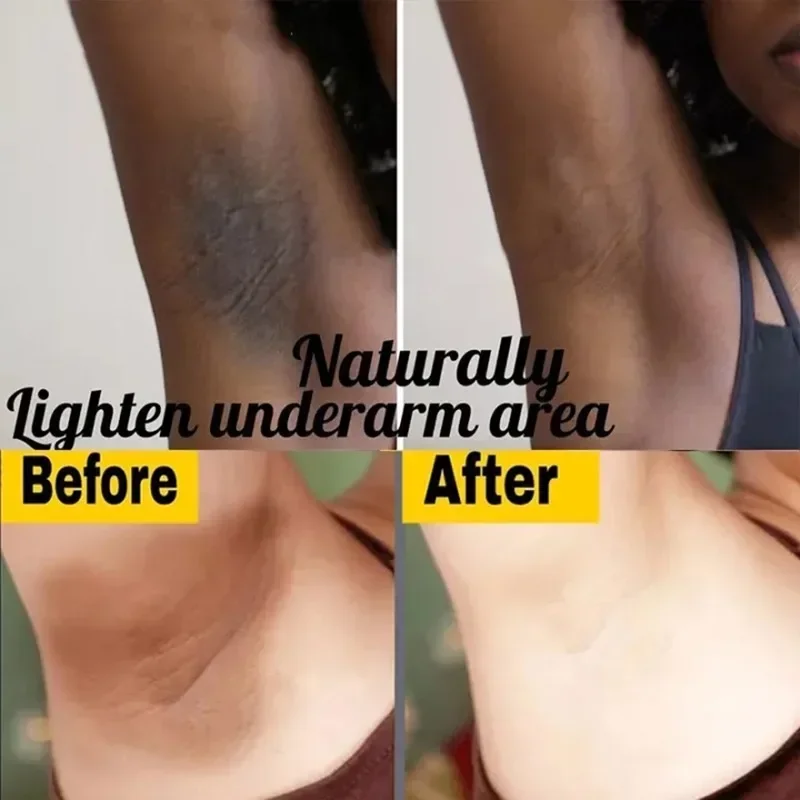 Peรงas Privadas Soro de Branqueamento das axilas, Branquear a bunda, Joelho iluminar a coxa interna, Partes รญntimas, Removedor Escuro, Melanina