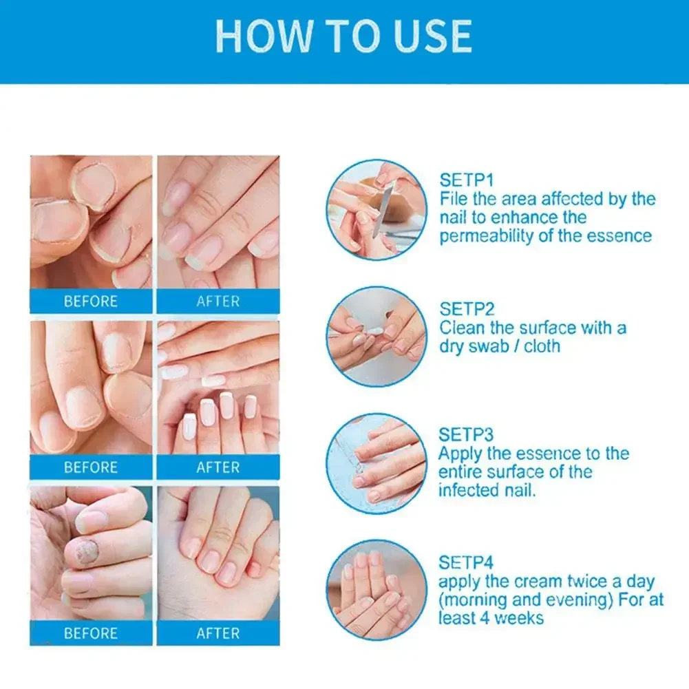 U&ntilde;as Fungus Nails Treatment for Fingernails Toenails Repair Onychomycosis Paronychia Anti Infection Toe Nail Fungal Removal