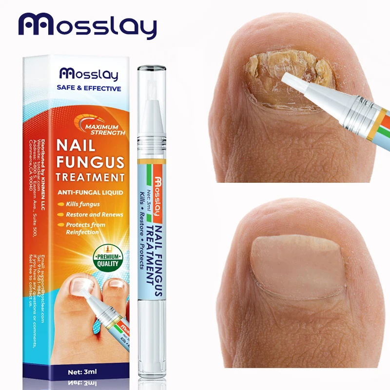 

A Super Strong Nail Repair Solution That Prevents Fungal Growth, Repairs and Renews Damaged Nails Ringworm of The Nails