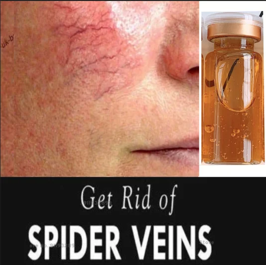 FAST Anti Redness & Spider Vein Removal Advanced Treatment Clearer Skin