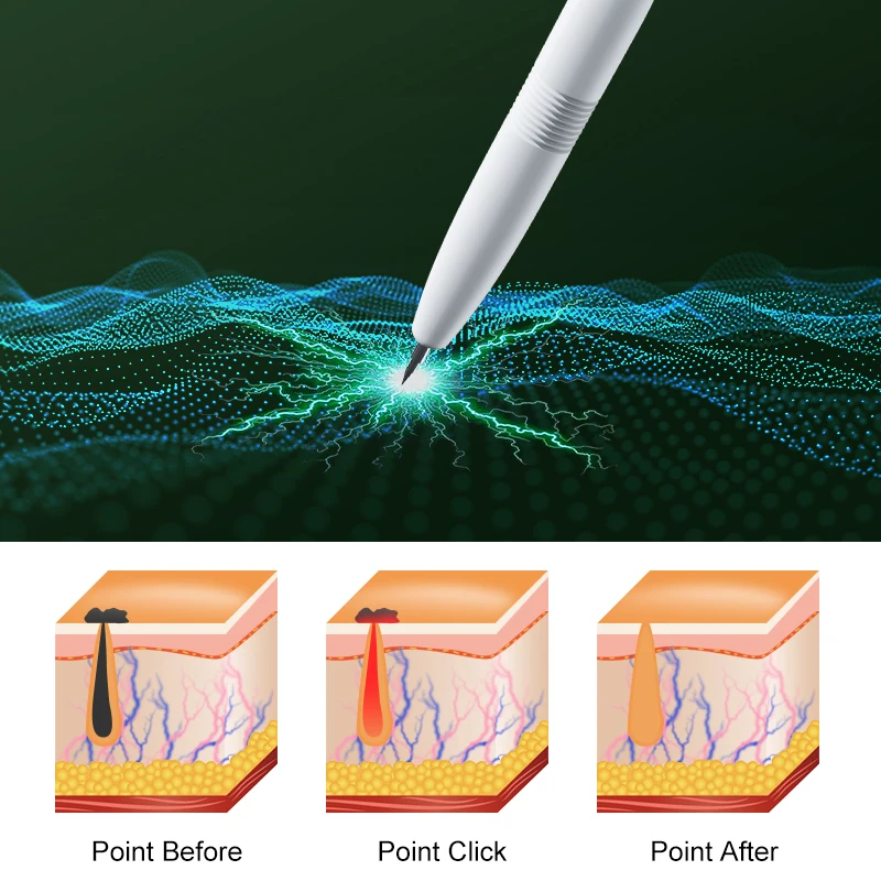 VLVEE 16 Levels LCD Facial Mole Removal Beauty Device Laser Plasma Pen Facial Beauty Instrument Remover warts Dark Spot Nevus Skin Tag Laser Plasma Pen Home Use