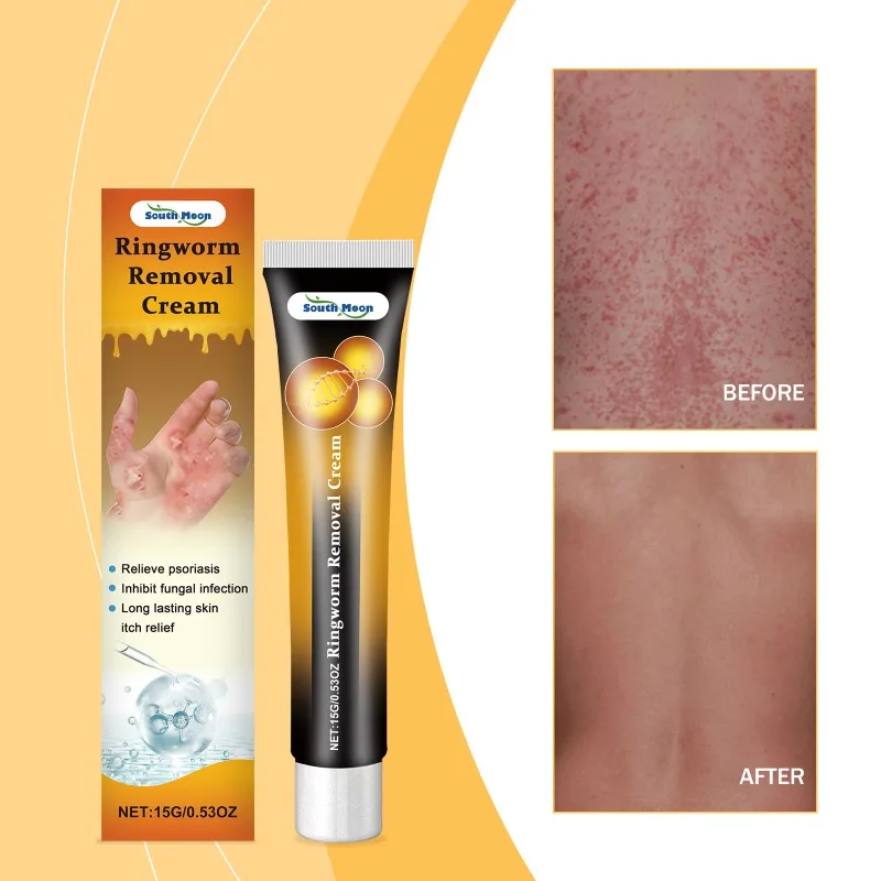 Ringworm Removal Cream Remove Dermatitis Relieve Skin Itching Swelling Fungal Inhibitor Desquamation Treatment Psoriasis