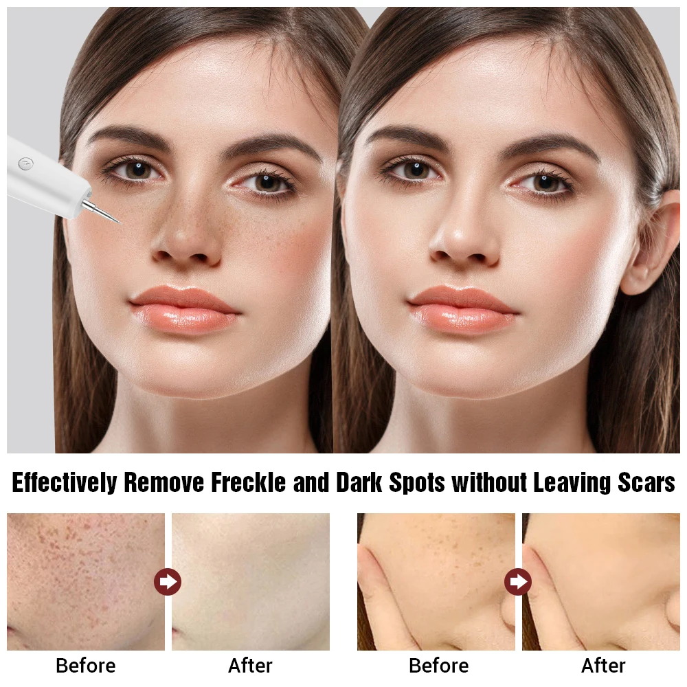 Laser Plasma Pen Mole Wart Eliminator Papilloma Skin Tag Remover Black Dots Freckle Dark Spot Remover Wireless Plasma Pen Beauty
